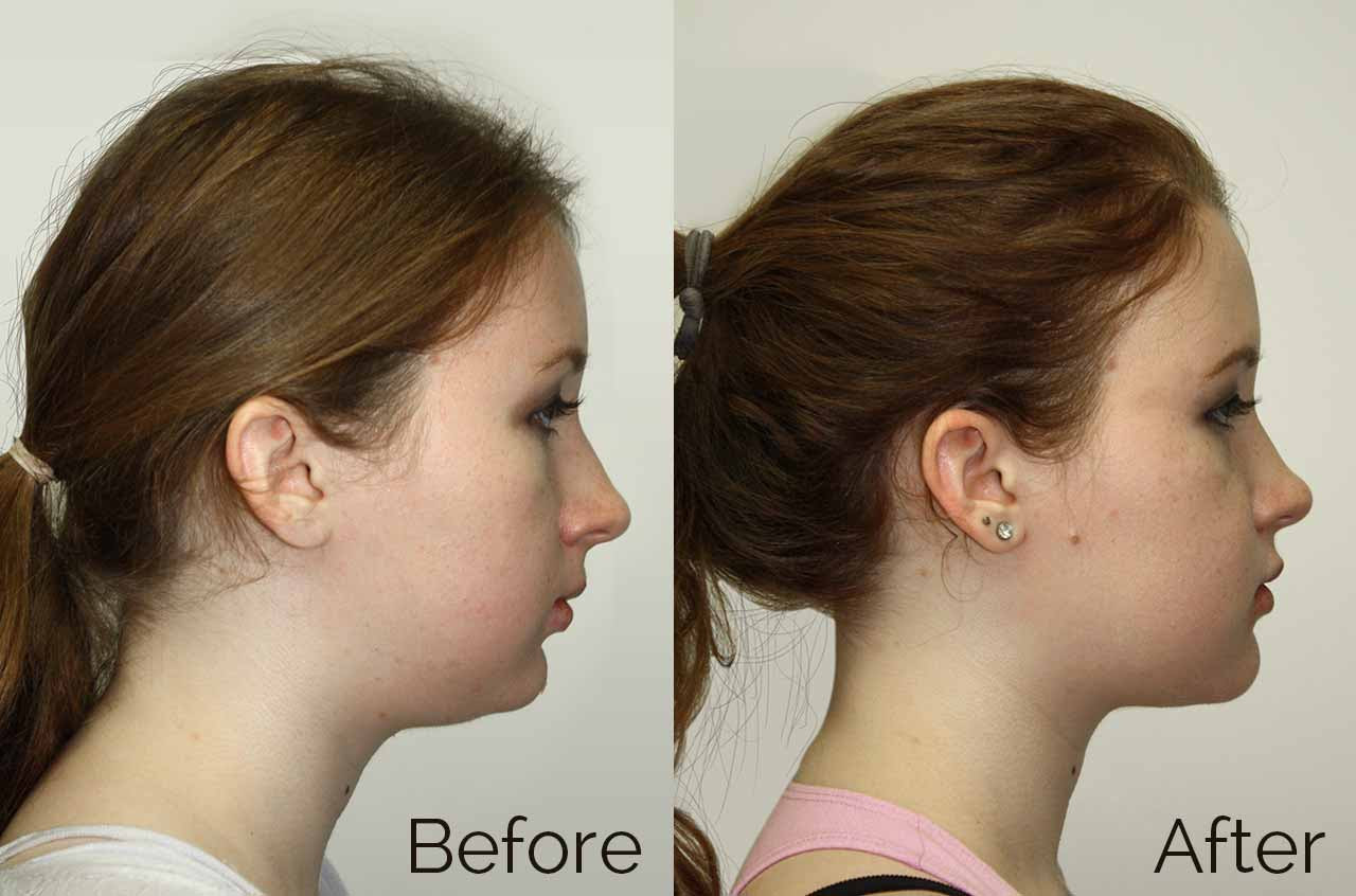 Do Nasal Strips Increase Performance does-mewing-change-your-face-shape-and-how-mewing-coach